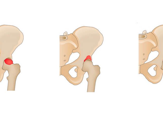 impacto femoroacetabular