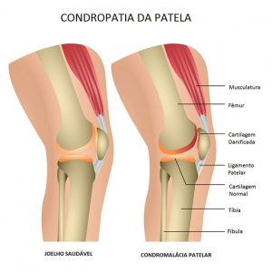 Condromalácia Patelar