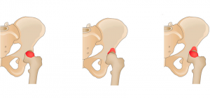 Impacto femoroacetabular
