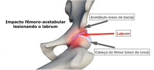 Lesão de Labrum