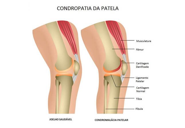 condromalácia patelar miniatura