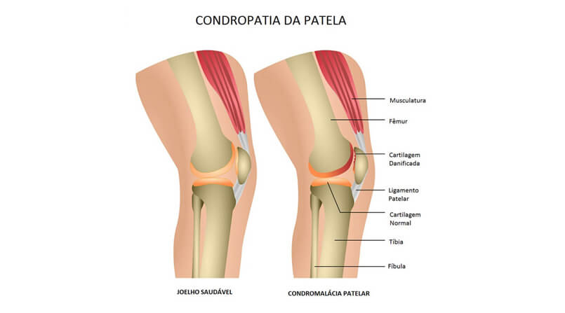 condromalácia patelar miniatura