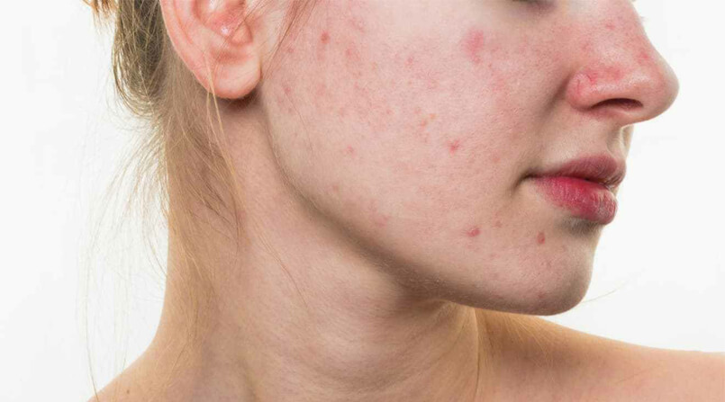 acne problemas mais comuns que afligem a pele